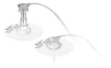 Portkanülensystem erhöht die Sicherheit