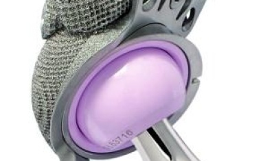 Hüftpfannenrevision: Jede Revision ist einzigartig…