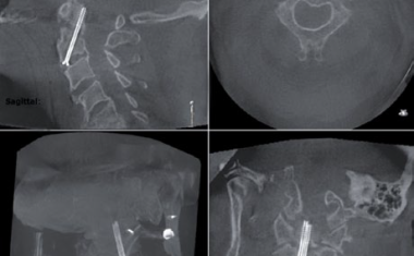 Intraoperative 3D-Bildgebung erhöht chirurgische Sicherheit