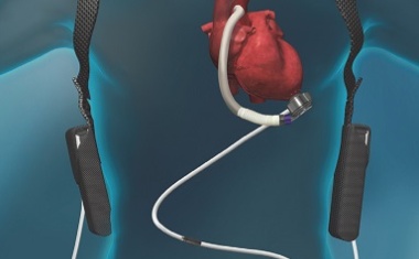 Herzinsuffizienz behandeln