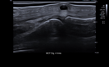 Patientenfreundliche Hochfrequenz-Sonografie