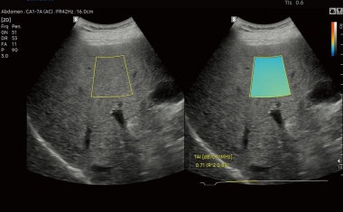 Präzise Leberdiagnostik