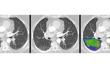 Photon-Counting-Computertomograph erhält FDA 510(k)-Zulassung
