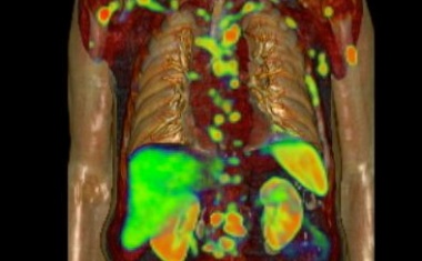Krebstherapie: Klaus Tschira Stiftung fördert Forschungsprojekt an der Nuklearmedizin Heidelberg
