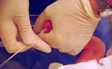 Neugeborenen-Screening auf schwere kombinierte Immundefekte