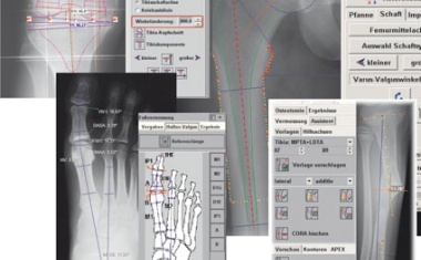 Endoprothetik: Digitale Planungsmodule verbessern Qualität