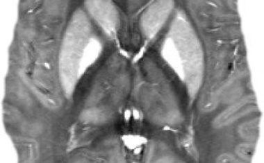 Medizinphysik: Wie magnetisierbar ist Hirngewebe?