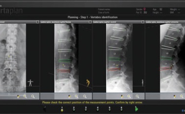 CS-System: Neue OP-Technik in der Bandscheibenchirurgie