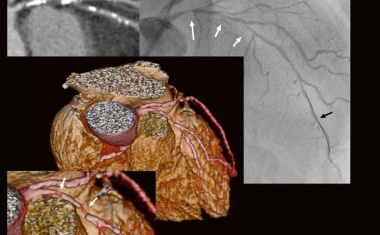 Ultraschnelle Herzbildgebung mit dem Low-Dose-Volumen-CT