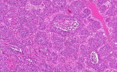 Maschinelles Lernen verbessert die Diagnostik bei Patienten mit Kopf-Hals-Tumoren