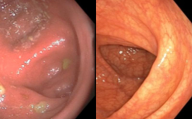 Lichttherapie hilft bei Nebenwirkungen von Krebstherapie