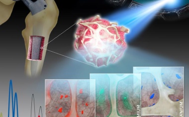 Langzeitrisiken von Implantaten
