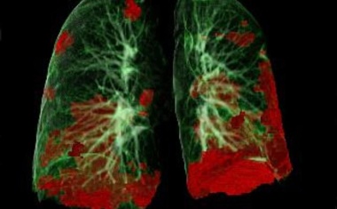 COVID-19 Langzeitstudie