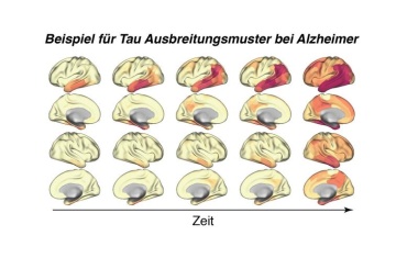 Der Weg zur individuellen Alzheimer-Prognose