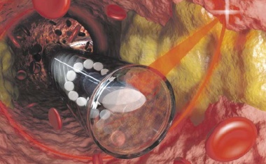 Mini-Endoskop entdeckt Ablagerungen