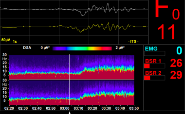 EEG-Monitoring bei Intensivpatienten mit COVID-19