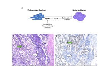 Schlüsselgen der Hodentumor-Entwicklung entdeckt