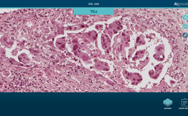 Analyse-System für die Brustkrebsdiagnose entwickelt