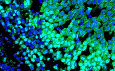 Zündschnur für Brustkrebs gefunden