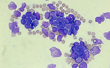 Blutkrebs-Studie: „Mächtige Zwerge“ gegen Leukämie