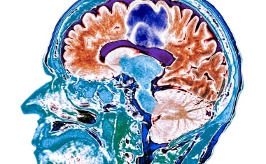 Radioimmuntherapie von Kopf-Hals-Tumoren
