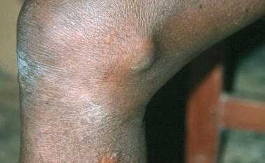 Millionenförderung für Bekämpfung der Flussblindheit