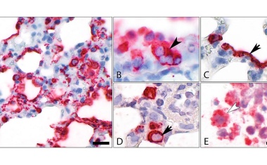 Lungenschäden bei COVID-19-Erkrankungen verstehen