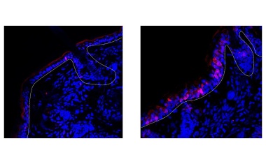 Mechanismus hinter mangelnder Wirkung von Schuppenflechte-Medikamenten identifiziert