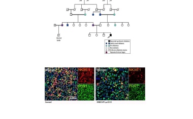 Neu entdeckter Gendefekt löst Diabetes aus