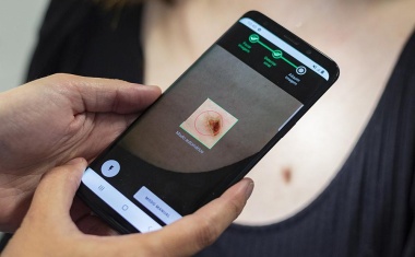 Smartphone-App und KI-Software beschleunigen Erkennung von Hautkrebs