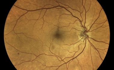 Auge liefert Hinweise auf schleichende Gefäßerkrankung