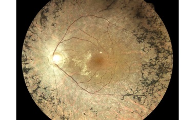 Bonner Zentrum für seltene Netzhauterkrankungen jetzt im Europäischen Referenz Netzwerk