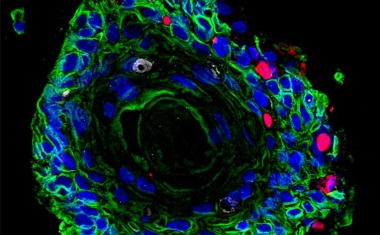 Krebs: Wenn Viren und Bakterien zusammenarbeiten