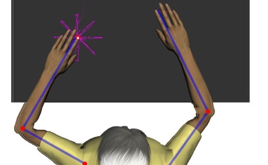 Nichtinvasive Hirnstimulation zeigt deutliche Effekte auf motorische Störungen nach Schlaganfall