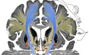 Optimierung der Tiefen Hirnstimulation bei Dystonie