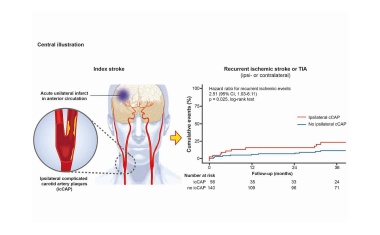 Neuer Risikofaktor für zweiten Schlaganfall