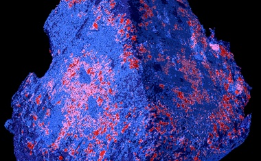 Personalisierte Medizin: Behandlung des akuten Hirnschlags