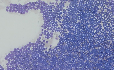 Blutkrebs: Verträglichere Therapie für ältere Menschen