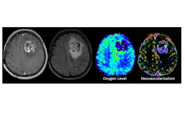 Exakte Diagnose von Hirntumoren mittels Künstlicher Intelligenz