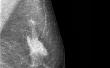 Brustkrebsvorsorge: KI verbessert Diagnose