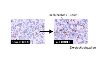 Immuntherapie bei Eierstockkrebs