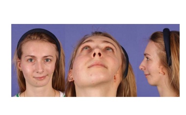 Behandlung von dentalen und skelettalen Fehlstellungen