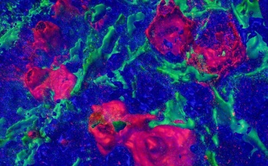 Studie untersucht Rolle des Proteins CD30 zur Früherkennung des Hodgkin-Lymphoms