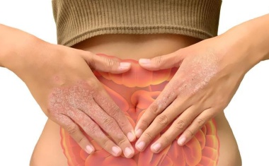 Darmerkrankungen erhöhen das Risiko für Schuppenflechte