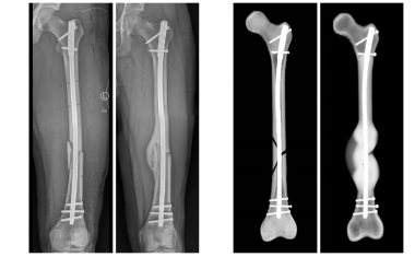 Computersimulation ermöglicht Prognose des Heilungsverlaufs von Knochenbrüchen