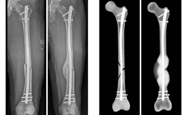 Computersimulation ermöglicht Prognose des Heilungsverlaufs von Knochenbrüchen