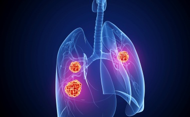Verbesserung der personalisierten Therapie bei Lungenkrebs durch digitale Vernetzung