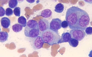 Knochenmarkkrebs Multiples Myelom: Antikörper verstärkt Wirkung etablierter Medikamentenkombination