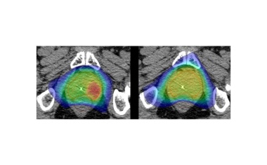 Internationale Studie: Prostatakrebs gezielt bestrahlen