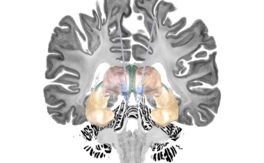 Hirnschrittmacher könnte Alzheimer-Erkrankung besser behandelbar machen